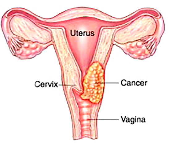 Image result for cervical cancer